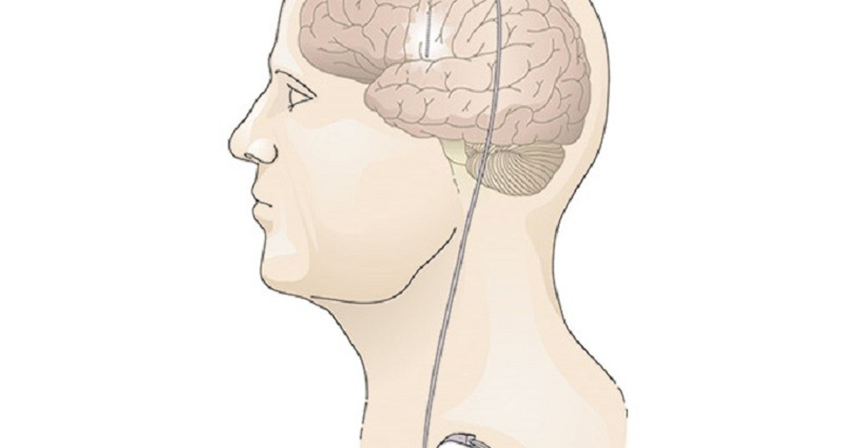 Deep brain. Стимуляция мозга. Глубокая стимуляция мозга. Нейростимулятор при болезни Паркинсона. Имплантат в головном мозге.